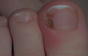 Onychomycosis