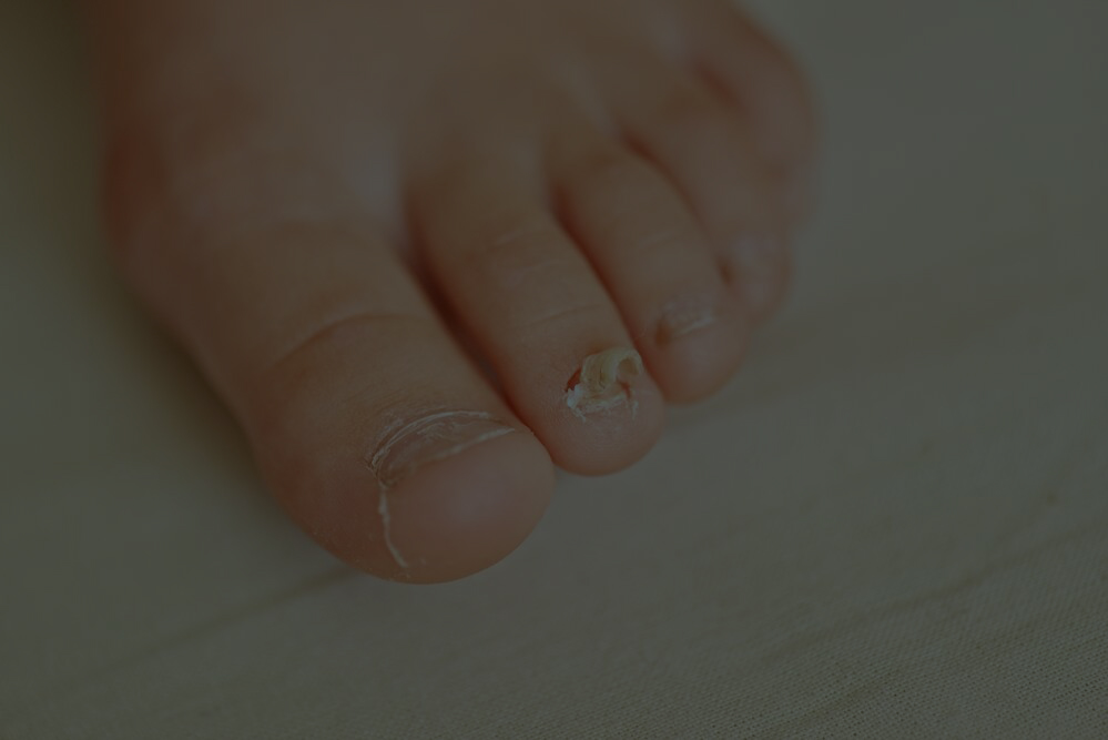 Nail Fungus